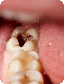 prevention-caries-petite-enfance-Dr-Gerot